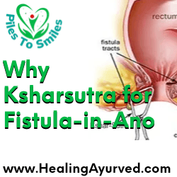 Ksharsutra treatment, a minimally invasive Ayurvedic therapy for fistula-in-ano, proven to be more convenient and effective than surgery.