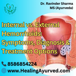 Learn about the differences between internal and external hemorrhoids, including symptoms, diagnosis, and treatment options.